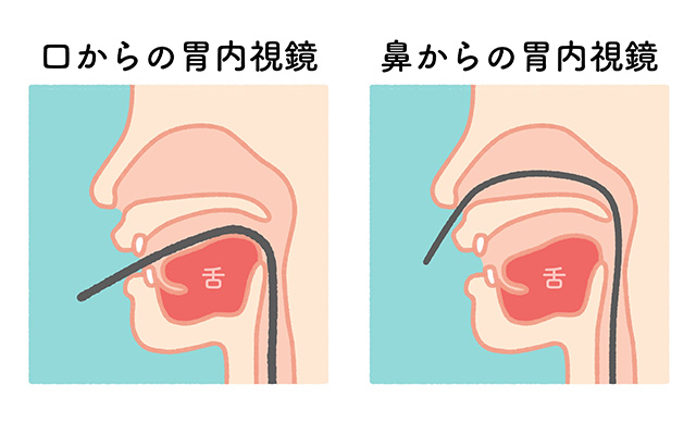 胃内視鏡の挿入方法のイメージ図