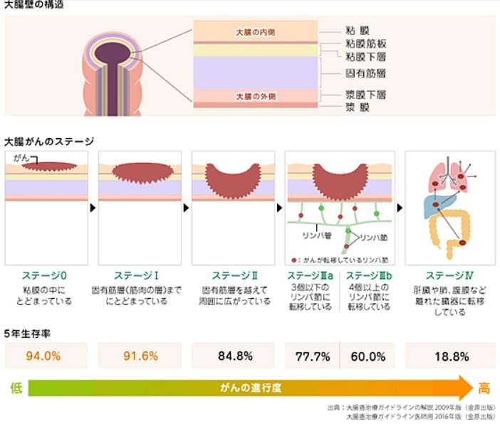 大腸壁の構造、大腸がんのステージのイラスト図