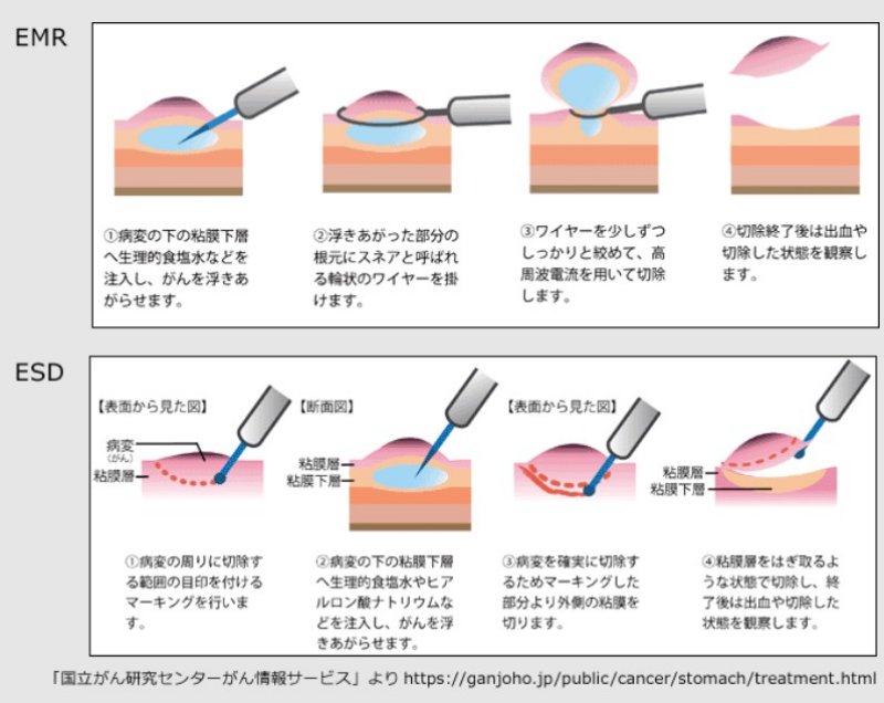 EMR、ESDのイラスト図